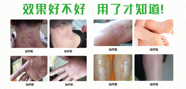 蕾丝视频APP黄真菌清喷剂
